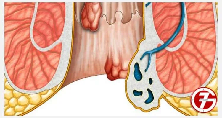 ما هى أعراض الاصابة بالبواسير؟