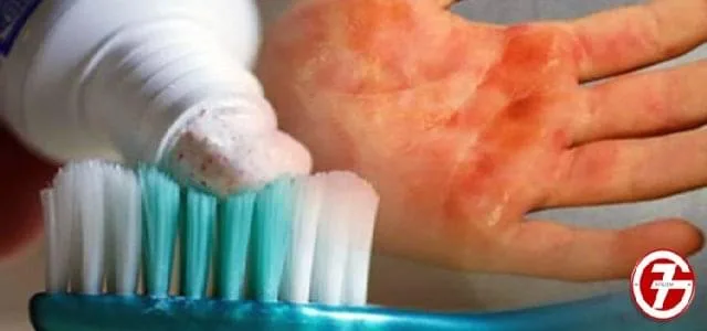 1- استعمال معجون الأسنان لتبريد الحروق